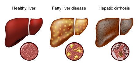 Fatty liver disease. Hepatic cirrhosis. Close-up of histology. Magnification of normal hepatocytes and cells of Fatty liver and cirrhosis. Vector illustrationのイラスト素材