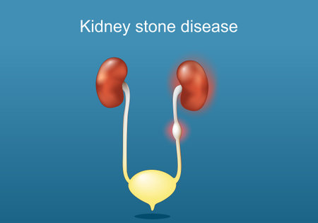Kidney stone disease. Anatomy human urinary system. Kidneys, ureter with stone, urinary bladder, and urethra. Renal calculi. Vector poster. Isometric Flat illustration.のイラスト素材