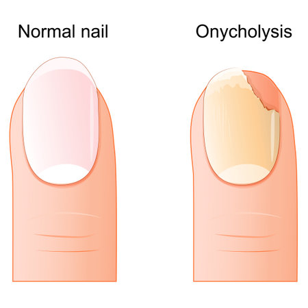 Onycholysis. Comparison and difference between a healthy fingernail and detachment of the nail plate from the nail bed. Nail health. Vector illustrationのイラスト素材