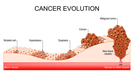 Cancer evolution from Mutated cell and Hyperplasia, to Dysplasia and Malignant tumor. Spread cancer cells to other tissues. Vector diagramのイラスト素材