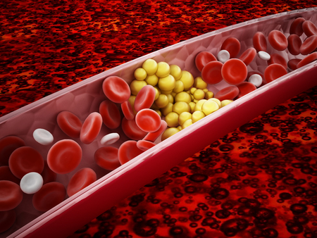 Fat cells blocking the blood flow inside human vein. 3D illustration.の写真素材