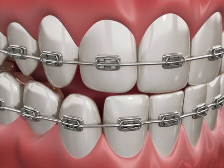 Illustration showing dental braces on straight teeth. 3D illustration.