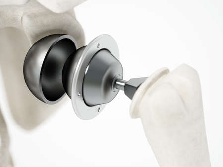 3D illustration of shoulder replacement surgery. 3D illustration.