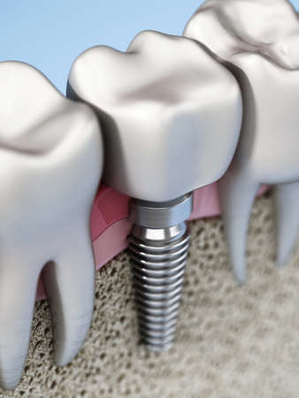 3D rendering of tooth implant showing jaw gum and bone layers. 3D illustration.