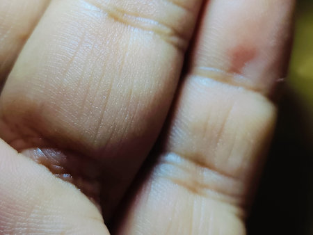 Close up of a wound on the skin of a human foot.