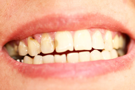 The tooth collapses after removing the braces, a hole in the tooth, caries.の写真素材