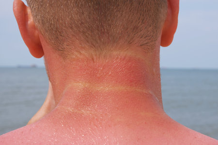 The man received sunburn on the seashore. The skin peels off. Protection of the skin from the sun.の写真素材