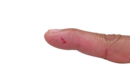 A wound at the fingerのeditorial素材