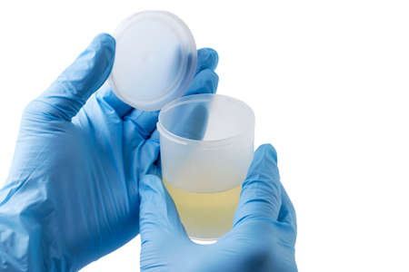jar of urine tests in a hand