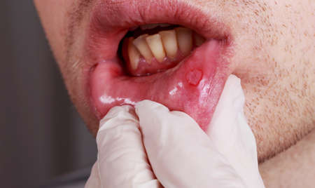 Stomatitis on the lips of a manの写真素材