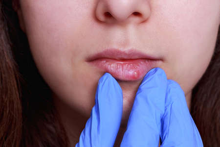 herpes on the lips of a young girl