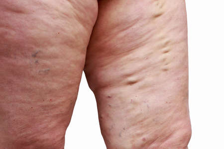 The disease varicose veins on a legsの写真素材