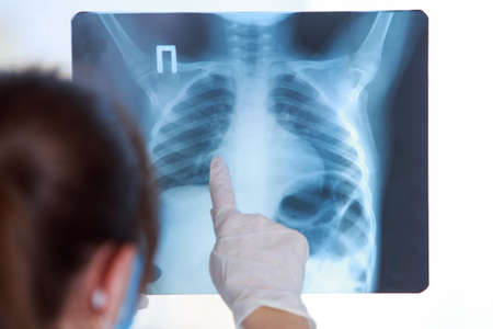 Doctor examines an X-ray of a lung