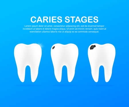 Stage of development of caries. Dental care concept. Healthy Teeth. Vector stock illustration.のイラスト素材