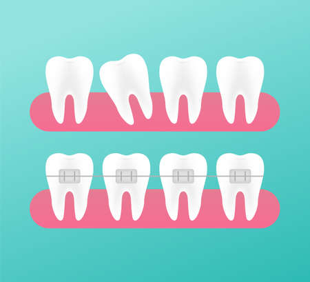 Correction of teeth with orthodontic braces. Stages of teeth alignment. Dental clinic services. Vector illustrationのイラスト素材