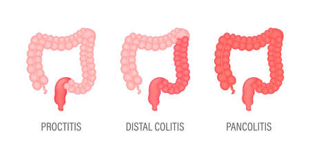 Colitis for medical design. Gastroenterology. Gut constipation icon design. Health care. Vector stock illustrationのイラスト素材