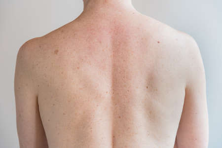 Back with a lot of moles and freckles. Concept of health. Examination by a doctor.の写真素材