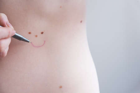 Moles on the skin with a painted smile. The concept of a healthy body. Checking the skin in the...