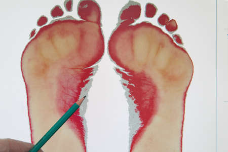 The doctor points out the signs of flat feet. The doctors hand in a glove points to the footprint...