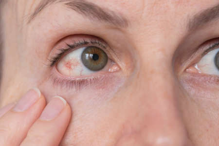 Reddened eye. Inflamed white of the eye. Burst capillaries. Overloading. Intracranial pressure, intraocular pressureの写真素材