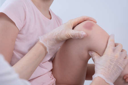 The doctor feels the childs knee. A teenage child with a knee injury. Bruising on the knee joint. Trauma, bruise, fracture. Doctors hands in gloves close-upの写真素材