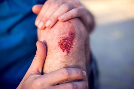 Emergency accident open abrasion wound trauma skin leg knee. People, healthcare and medicine conceptの写真素材