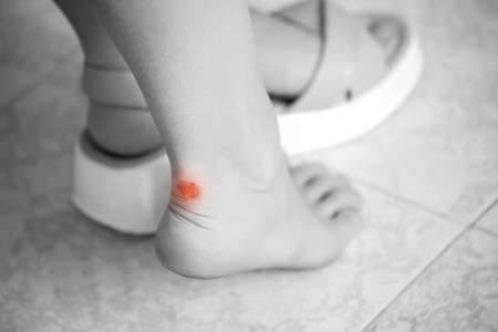 Callus on skin of legs of woman. Health care and medicine conceptの写真素材