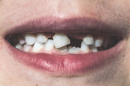 Child shows missing teeth. Child faceの写真素材