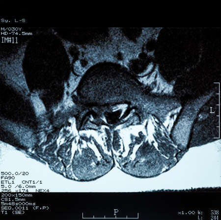 Magnetic resonance imaging (MRI) of lumbo-sacral spines: demonstrated herniated disc at L3-L4 and L4-L5の写真素材