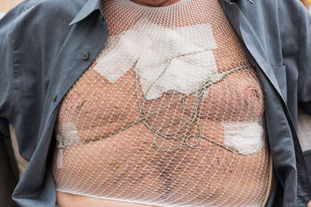 Portable holter for cardiac monitoring of electrical activity of the cardiovascular system attached to a male senior patient's chest during a 24 hour diagnostics processの写真素材