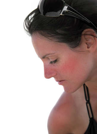 Sunburn: closeup profile portrait of young woman with sunburnの写真素材