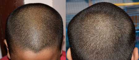 Front and Rear Side of Hair Follicles of a childの写真素材