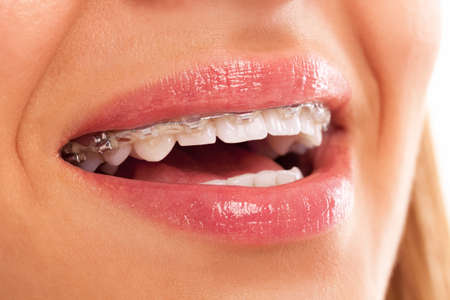 dental fix prosthesis close upの写真素材