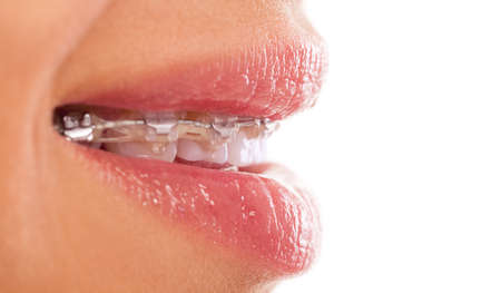Beautiful teeth braces close upの写真素材