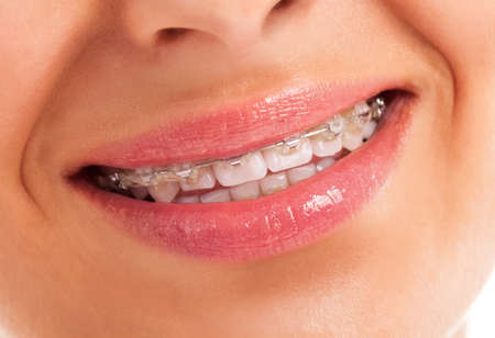 Details of teeth with braces isolated