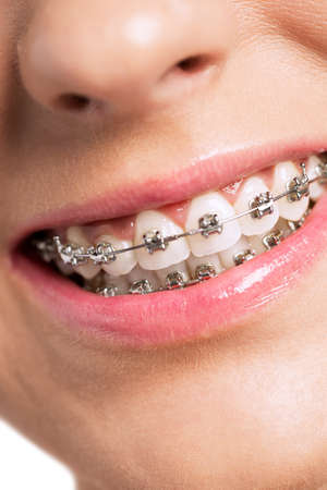 Happy healty woman with braces
