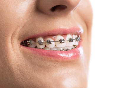 Close up of braces girls perfect teethの写真素材