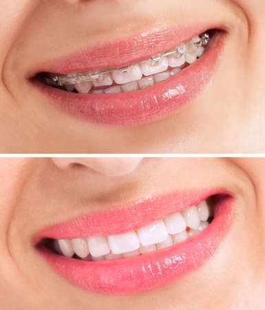 Perfect teeth before and after braces close upの写真素材