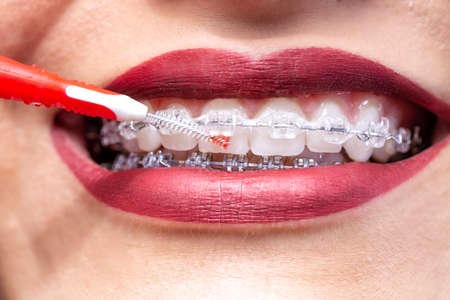 Proxabrush for in between teeth area hygiene, braces conceptの写真素材