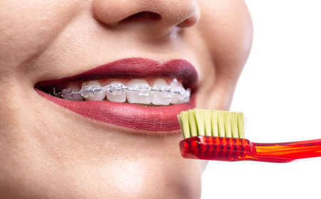Close up of white teeth with braces and a toothbrushの写真素材