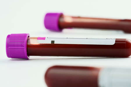 Vacuum tubes for collection and blood samples on white background. Transparent with purple and green lid. Label to identify the data. Selective focus.の写真素材