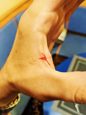 Hand Injury. Incised wound on the hand between the fingersの写真素材