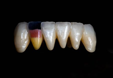 Ceramics bridge teethの写真素材