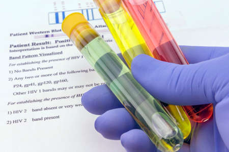Blood sample and lab request for anti-HIV testingの写真素材