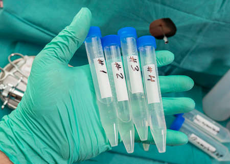 Vials with four samples of cerebrospinal fluid in patients with transverse myelitis after being...