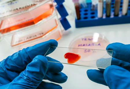 Scientist examines blood sample from sick person with malaria in laboratory, conceptual image