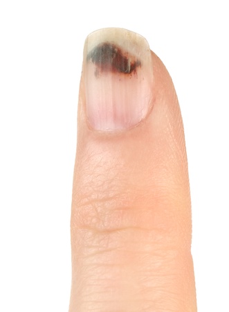 Finger with Bruised Nail (Subungual Hematoma) on White Background)の写真素材