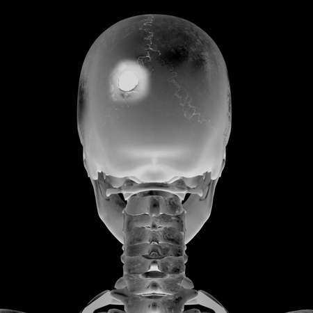 3D Radiograph with head injury