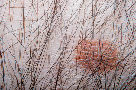 Large mole on a man's skin. Close-up of the birthmark at high magnification in soft focus. An image on the topic of medicine and dermatology.の写真素材