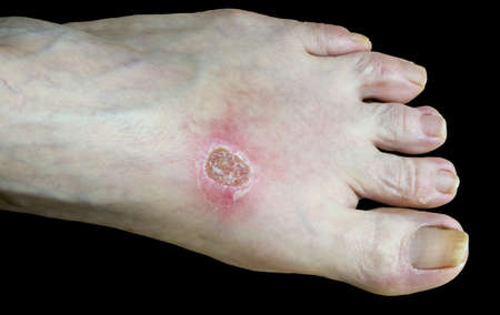 healing foot after being burned by boiling waterの写真素材